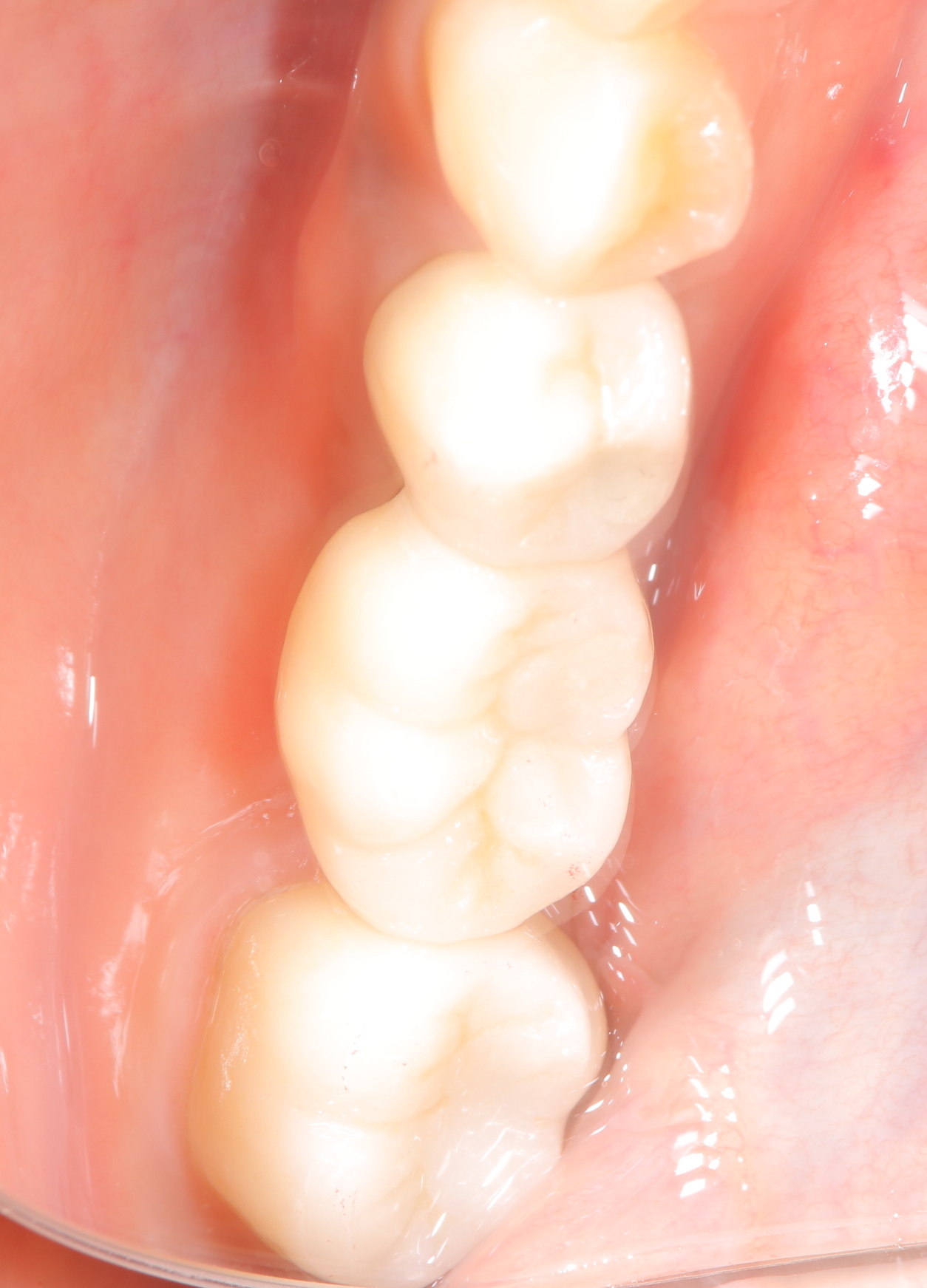 歯根破折歯のインプラント埋入