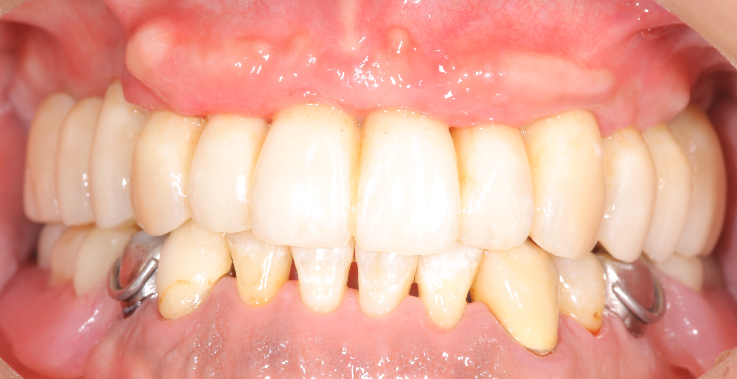 インプラントを埋入することで総義歯から固定式ブリッジヘ
