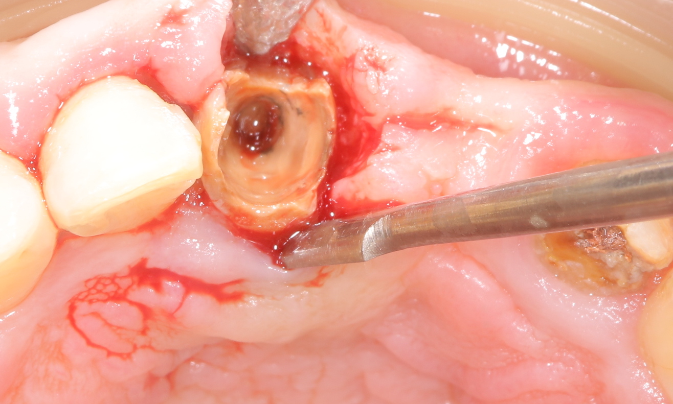 歯冠長増大術
