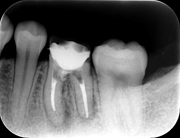 歯根の破折部をMTA