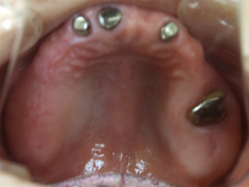 上顎総義歯からインプラントによるAGC（固定性の冠）