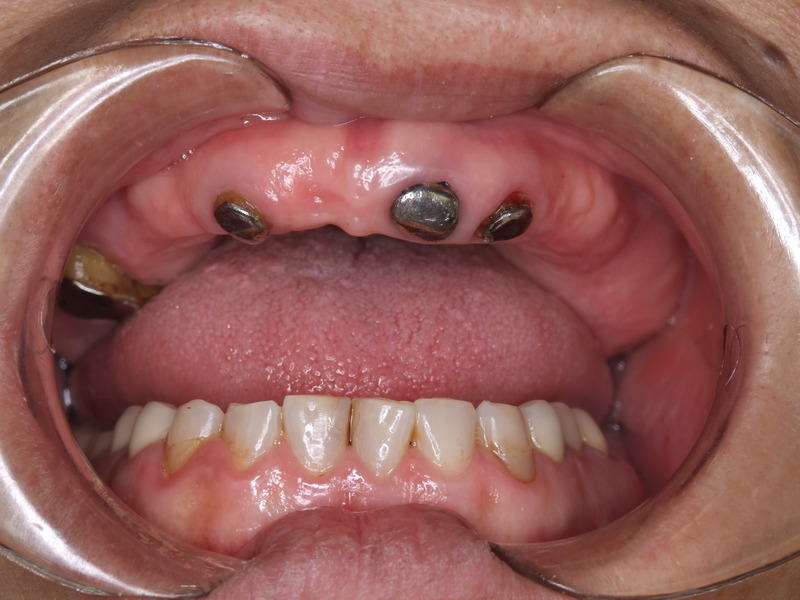上顎総義歯からインプラントによるAGC（固定性の冠）