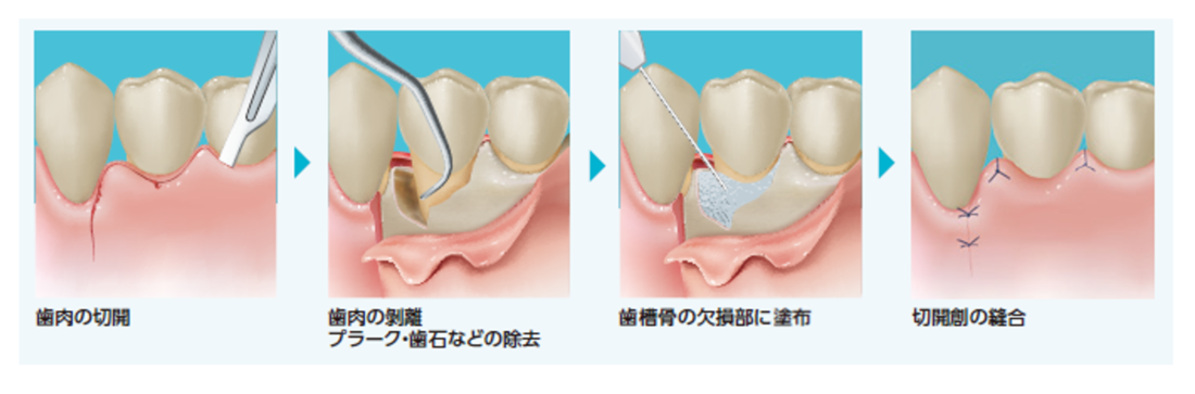 新時代の歯周外科 切開と縫合の基本から拡大視野下の手術手技 - 本